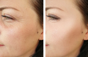 woman face wrinkles before and after treatment - obrazy, fototapety, plakaty