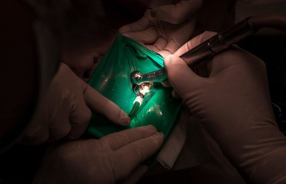 tdentistry. dental treatment, close-up. teeth and caries.