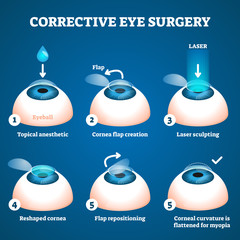 Corrective eye surgery vector illustration. Laser process education scheme. - obrazy, fototapety, plakaty