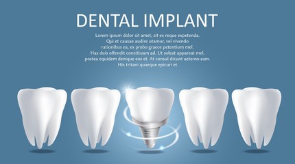Dental implant vector medical poster banner template