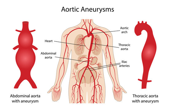 Aortic aneurysms: Thoracic and Abdominal. Arterial circulatory system of the abdominal. Abdominal aorta and thoracic aorta with aneurysm. Vector illustration in flat style isolated on white background