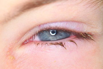 Conjunctivitis is a viral bacterial infection in the eye of a boy.