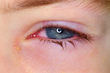Conjunctivitis is a viral bacterial infection in the eye of a boy.