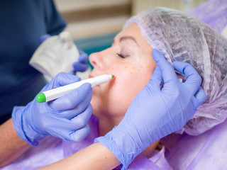 A woman's face is being prepared for plastic surgery. Doctors draw with a special marker on the face