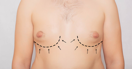 Male body, male breast plastic, gynecomastia. Male Breast Adjustment, Plastic Surgery, Background, medical - obrazy, fototapety, plakaty
