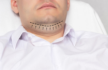 A man with a double chin in the office of a plastic surgeon. Marking with a black dash-dot line...