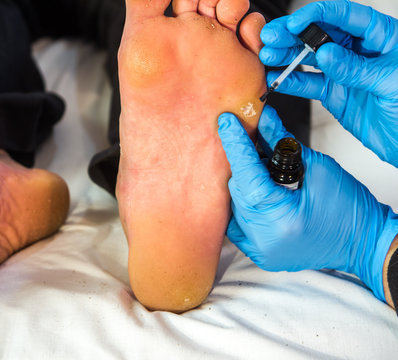 examination of a wart on a right foot by a doctor with blue gloves and medical utensils