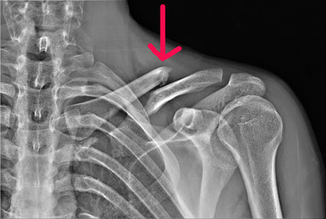 radiography of the shoulder joint and ribs in direct projection with a fracture of the clavicle with displacement, Traumatology and orthopedics - obrazy, fototapety, plakaty