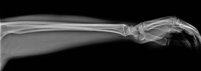 normal radiography of hand and wrist bones, traumatology and orthopedics, traumatology
