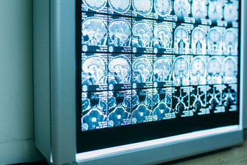 MRI scan image of brain on negatoscope background