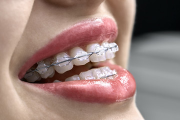 Closeup view at female teeth with bracket system