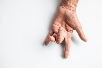 Obraz premium Trigger Finger a defect in a tendon causing a finger to jerk or snap straight when the hand is extended.
