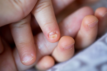 Onychomycosis nail disease close-up macro in a child. Children's injury to the fingernail.