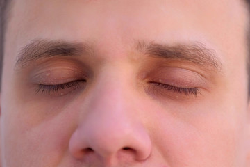 Face of young man on light background with small papillomas on eyelids. Guy demonstrating growths on the eyelids skin with closed his eyes, face closeup. View before laser removing.