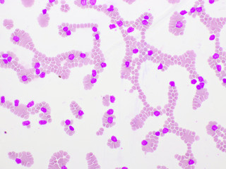 Picture of acute lymphocytic leukemia or ALL cells in blood smear, analyze by microscope, 400x