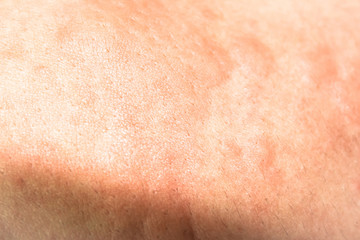 urticaria on skin. rashes, of which urticaria and toxic erythema are the most common.