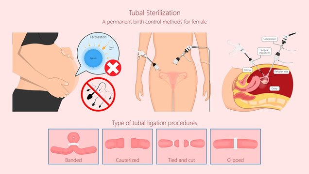 Tubal ligation surgery permanent birth control blocked prevent egg ovary tie uterine banded cauterized sterilizes block