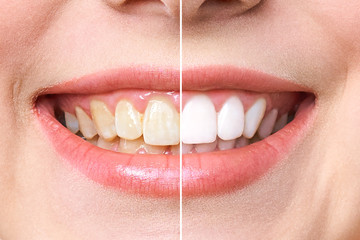 woman teeth before and after whitening. Over white background. Dental clinic patient. Image...