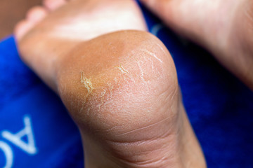 Corn callus cracks on a sole heel foot close up. Dry skin dermatology problem.