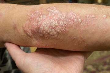 Dermatological problem, the elbow of man with psoriasis-affected skin