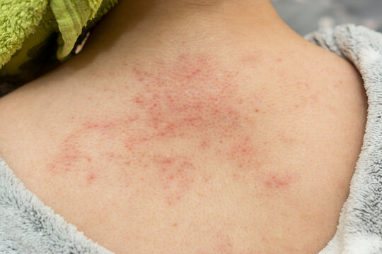 How to manage prickly heat on the back? - Dr. Aruna Prasad