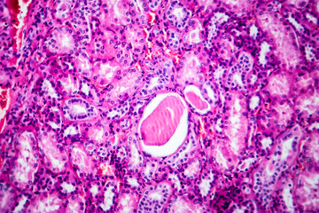 Histopathology of hypertensive renal disease, light micrograph, photo under microscope