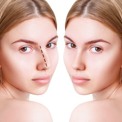 Young woman with dotted line on nose before and after plastic surgery.