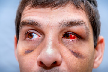 face of a white person with bruises under the eyes and an eye damaged with blood