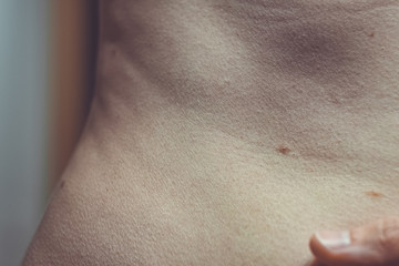 Fototapeta premium Melanocytic nevus, some of them dyplastic or atypical, on a caucasian man of 37 years old from Spain