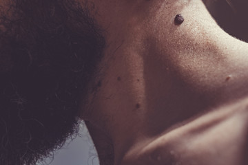 Fototapeta premium Melanocytic nevus, some of them dyplastic or atypical, on a caucasian man of 37 years old from Spain