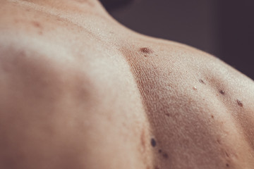 Melanocytic nevus, some of them dyplastic or atypical, on a caucasian man of 37 years old from Spain
