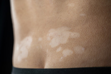 White men with hypopigmentation, white patches without pigment on back just above bum