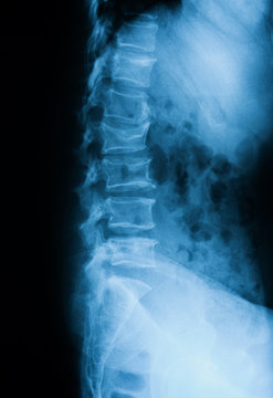 X-ray image of lumbar spine (L-spine), lateral view. showing compression fracture of spine