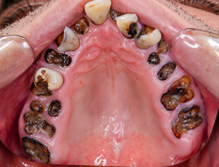 oberkiefer, intraoral mit zerstörten zähnen © Dirk