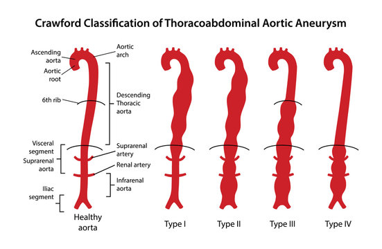 Crawford Classification of Thoracoabdominal Aortic Aneurysms. Healthy aorta with main parts labeled and aorta with four types of Thoracoabdominal aneurysm. Vector illustration in flat style