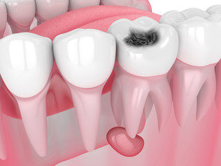 3d render of jaw with tooth cavity and cyst