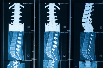 Image Magnetic resonance imaging of the human spine MRI