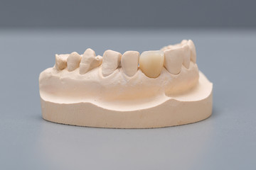 Dental imprint with artificial dentition in a dental laboratory ready for use