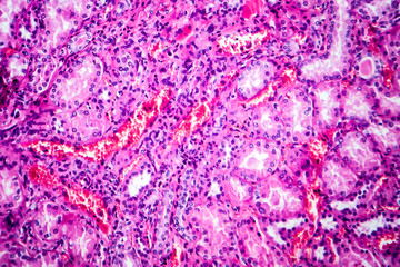Histopathology of hypertensive renal disease, light micrograph, photo under microscope