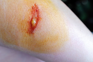 Close-up of a wound with pus in a person