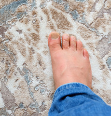 fungus and calluses formed on the toes, a neglected human foot,