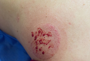 Chinese bleeding technique to decrease pain and stress of the trapezius