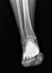normal radiograph of the ankle joint in front projection,osteoarthritis osteoporosis
