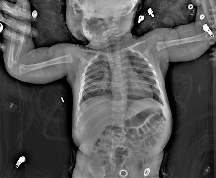 normal radiography of the child's chest and abdomen in direct projection, medical diagnosis
