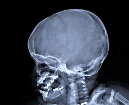 normal x-ray of the skull in lateral projection