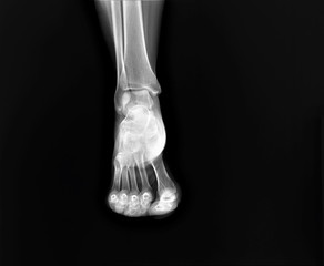 Fototapeta na wymiar normal radiograph of the ankle joint in front projection,osteoarthritis osteoporosis
