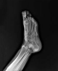 normal radiography of the foot, medical diagnostics, traumatology and orthopedics, rheumatology