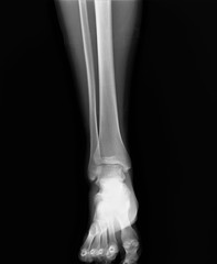 normal radiograph of the ankle joint in front projection,osteoarthritis osteoporosis