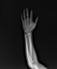 Obraz premium normal radiography of hand and wrist bones, traumatology and orthopedics, traumatology