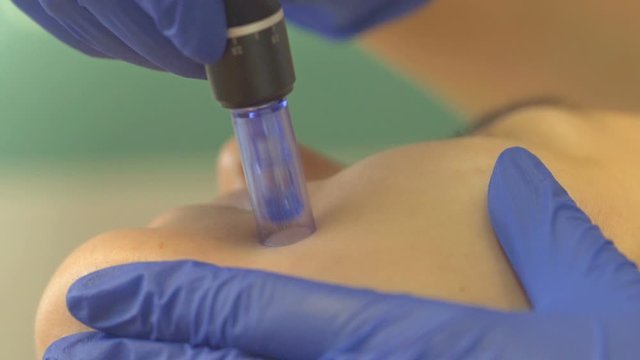 Cosmetologist making mesotherapy injection. Microneedle mesotherapy. Close up, slow motion